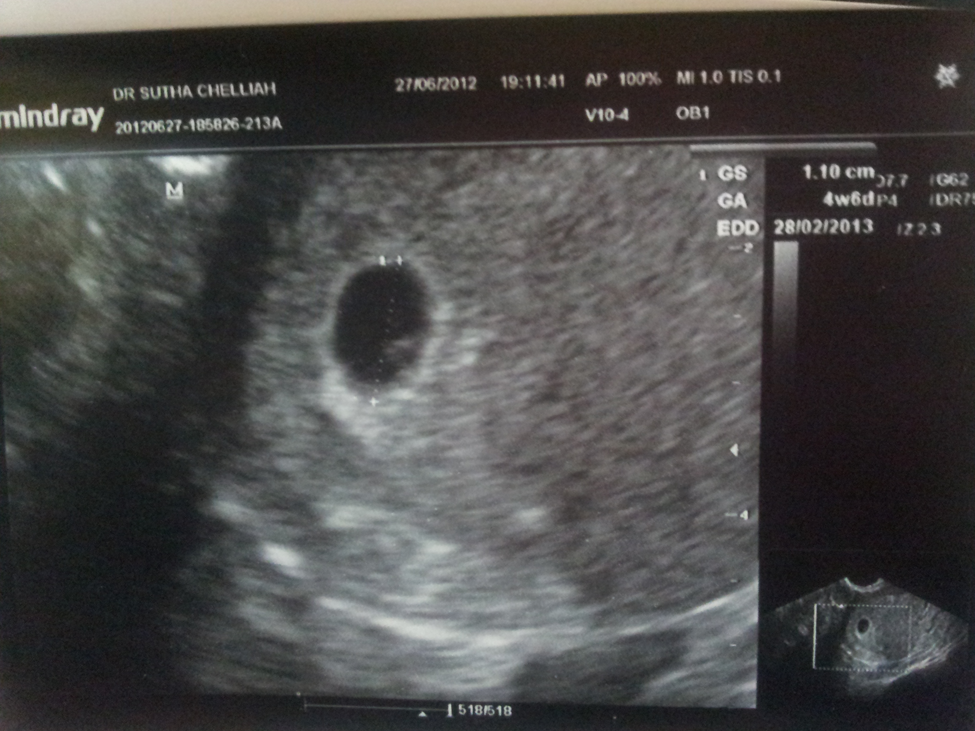 Weeks ultrasound days 4 4 5 week